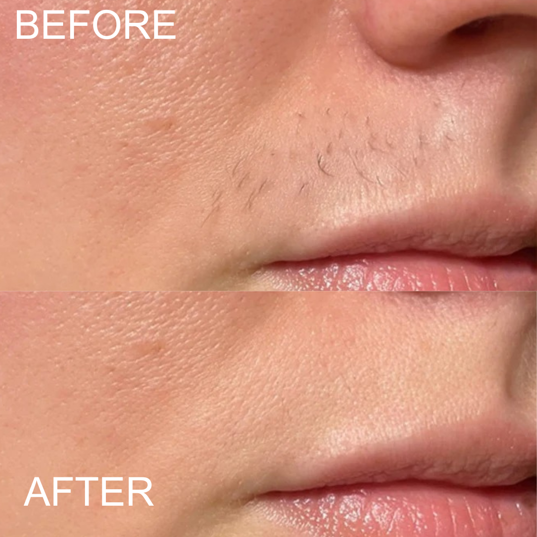 Blissye- Facial Hair Remover