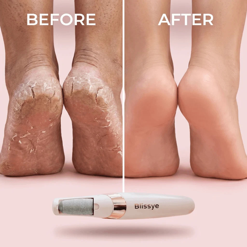 BLISSYE CALLUS REMOVER