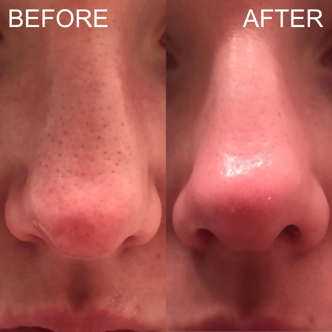 Blackhead Vacuum